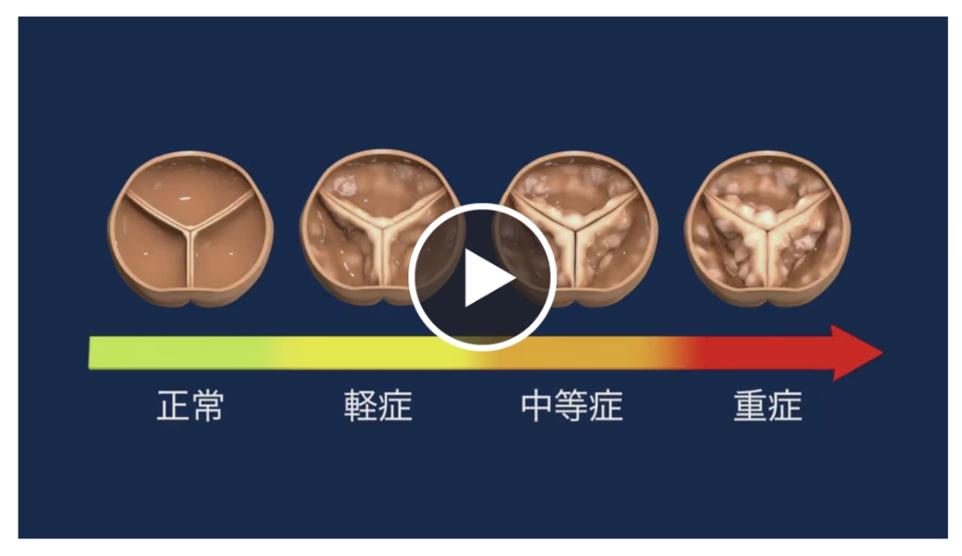 病気の進行についての動画